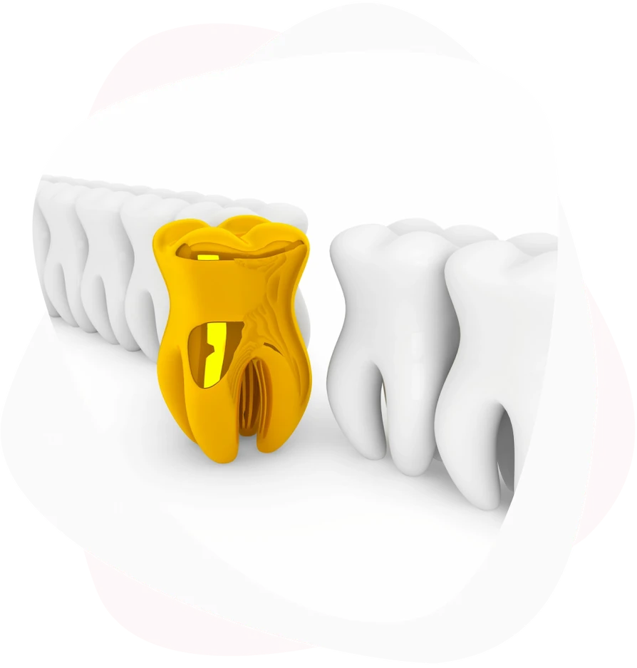 быстрая и выгодная скупка стоматологического золота 